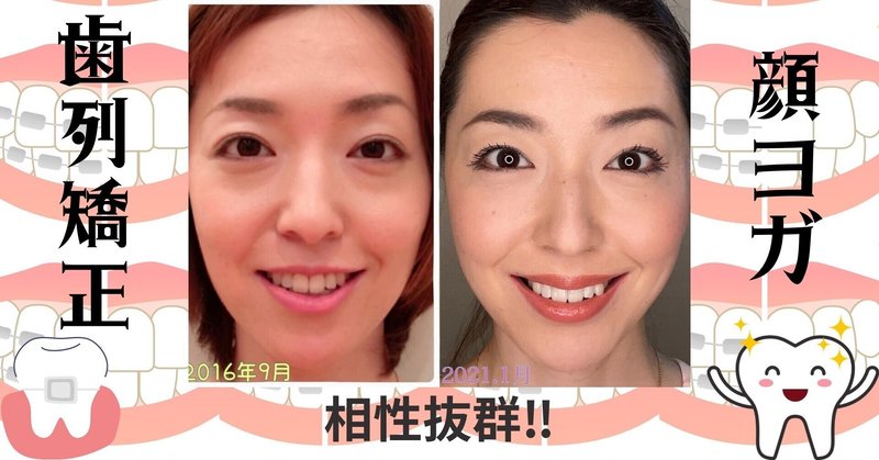 歯列矯正と顔ヨガは相性抜群 このチャンスを逃さないで 今泉 八重 顔ヨガ 観相学 ピラティス 幸運 は表情美人 姿勢美人の元へやってくる Note 歯列矯正と顔ヨガは相性抜群 このチャンスを逃さないで 今泉 八重 顔ヨガ 観相学 ピラティス 幸運 は表情美人 姿勢美人の元へやってくる Note