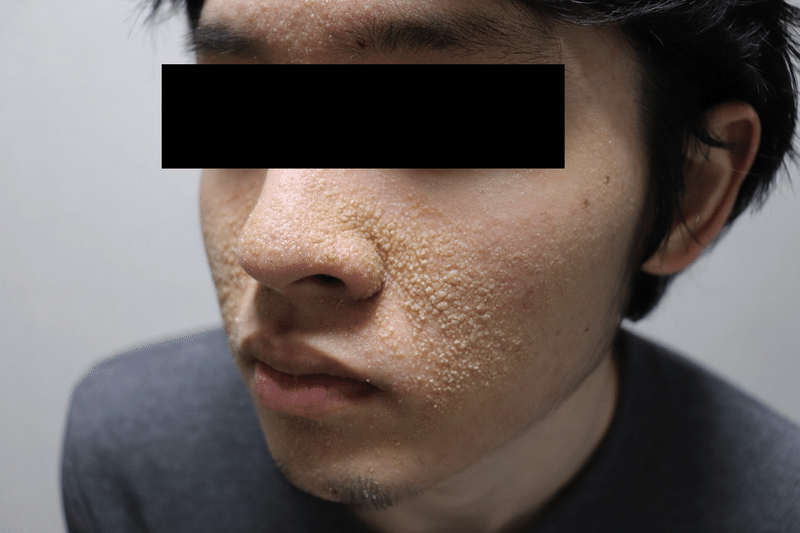 ベスト 汚肌 画像 芸能人 汚肌 画像