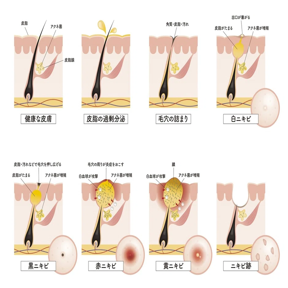 意外と知らない ニキビ と 吹き出物 の違いと中々お得な話 健康ソムリエ 毎日野菜健康生活 月間1万pv突破 Note