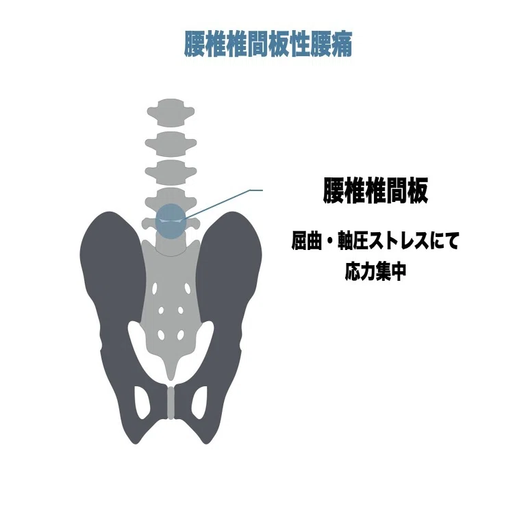 腰部屈曲時に背側から下肢に症状が出現する患者の評価・治療の実際(全２枚) 屈曲型腰痛の評価とアプローチ｜平 純一朗｜理学療法士×アスレティック