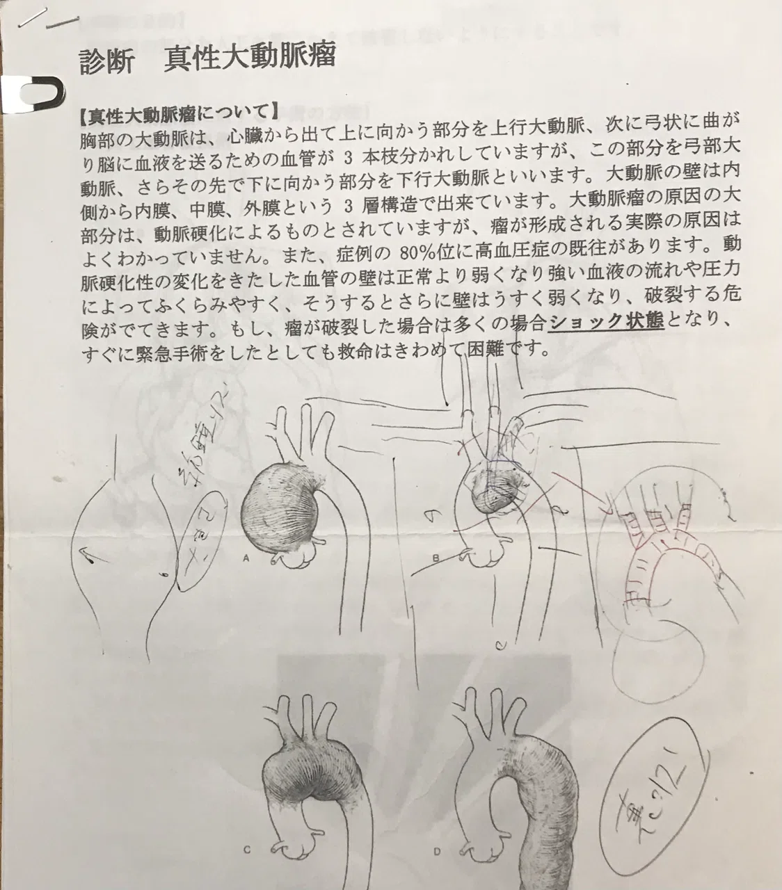 心臓手術（胸部大動脈瘤人工血管置換手術）のこと｜おきな
