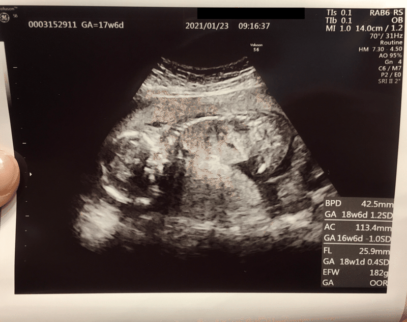 ３回目の妊婦検診17w6d うに 体外受精39歳 40歳 Note