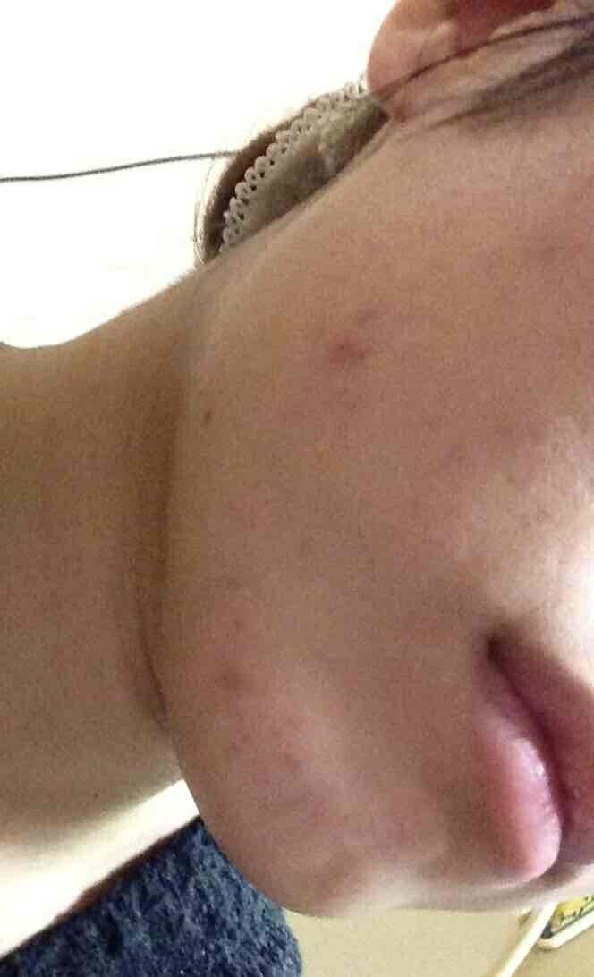 肌荒れ ニキビのお話 画像有 名無し Note