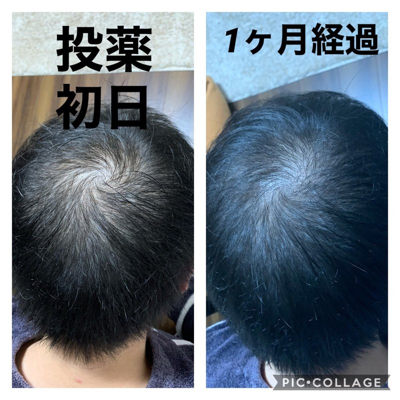 Aga治療はじめました 経過報告と副作用について えいち Note Aga治療はじめました 経過報告と副作用について えいち Note