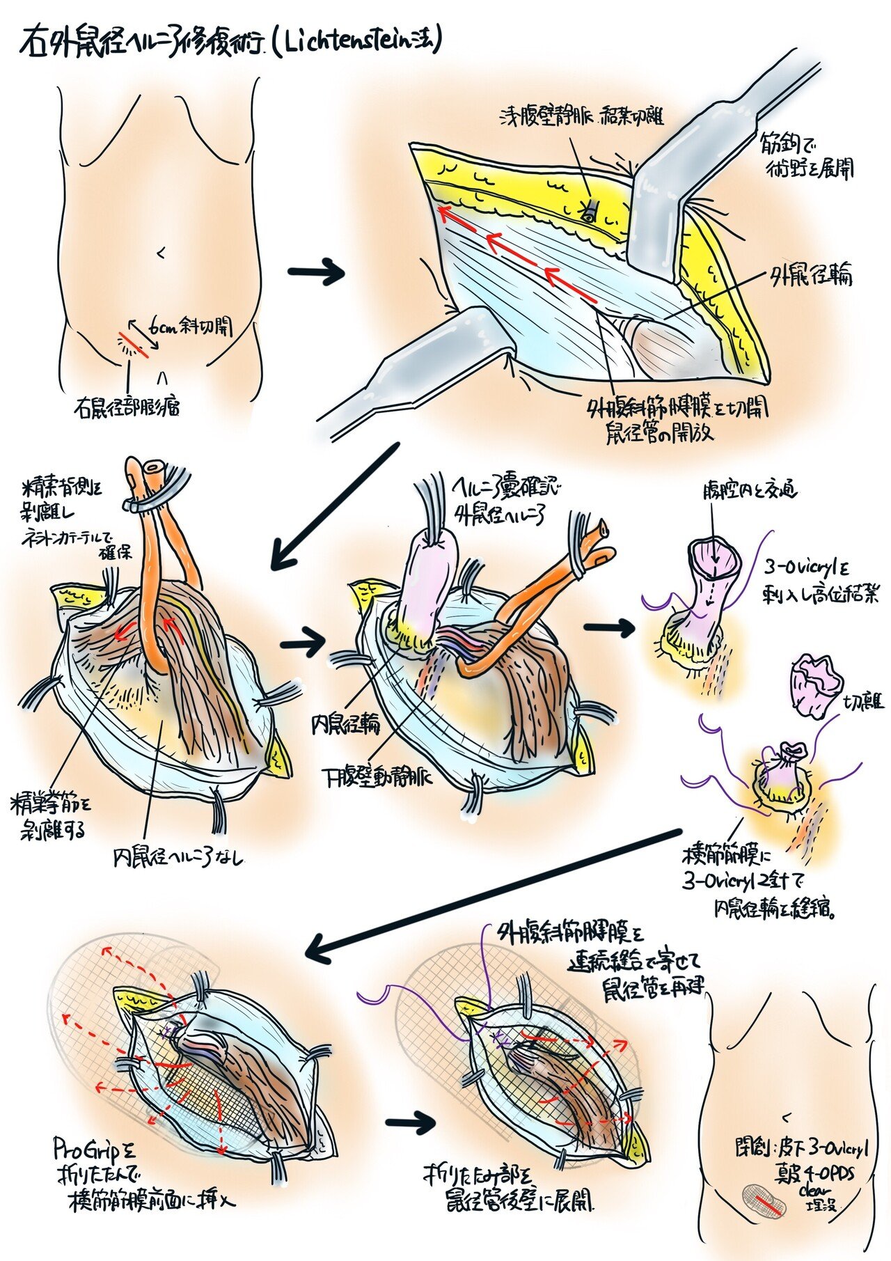 iPadで描くオペレコ④｜オペ中