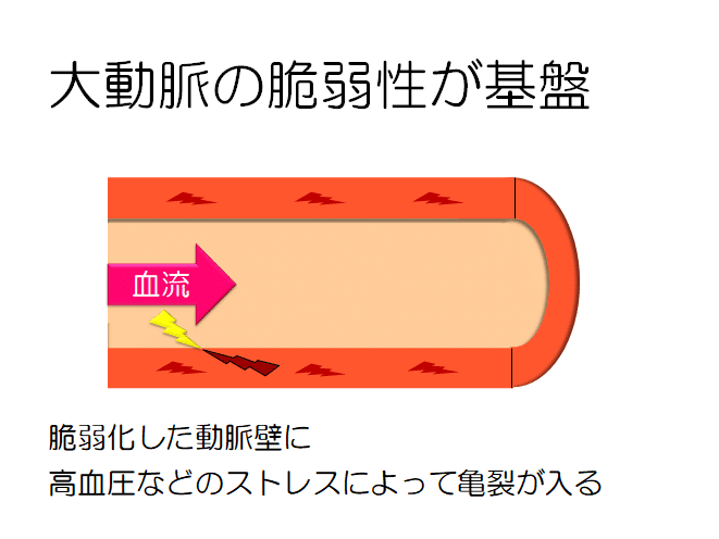 大動脈解離のリハビリテーション 病態 飯沼 優 理学療法士 Note