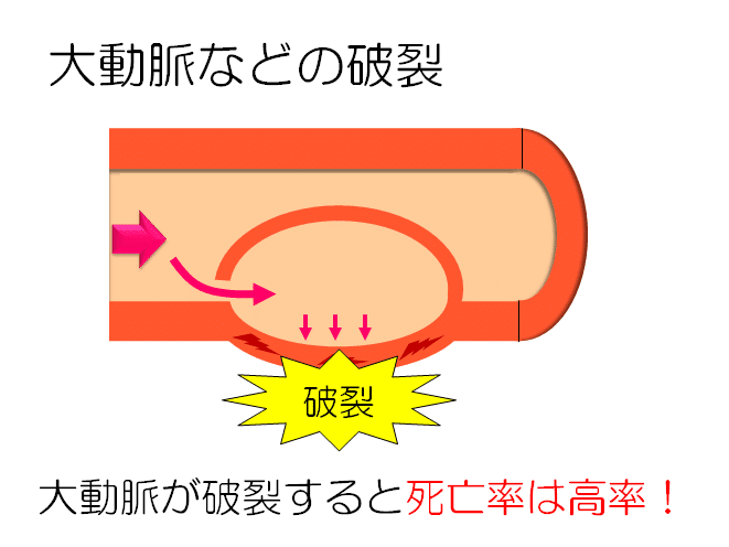 大動脈解離のリハビリテーション 病態 飯沼 優 理学療法士 Note