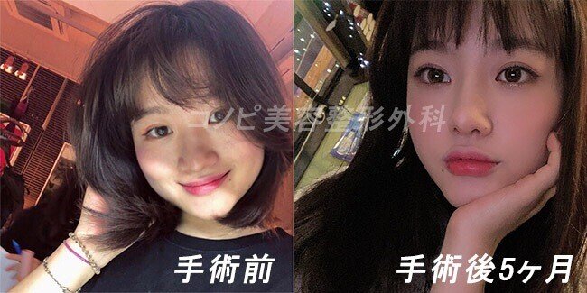 鼻整形 何歳から可能ですか ジョン テヨン院長 鼻整形専門 Note 鼻整形 何歳から可能ですか ジョン テヨン院長 鼻整形専門 Note