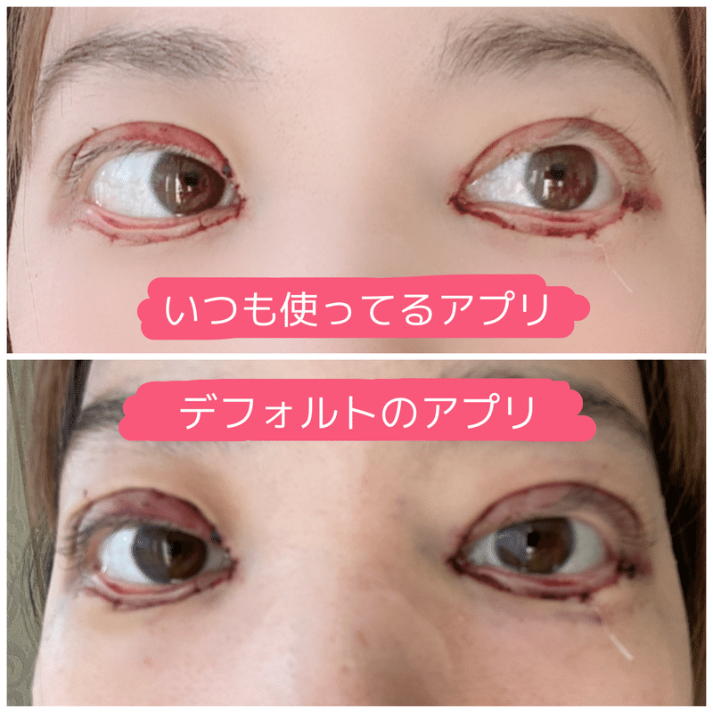 逆さまつげの手術 保険適用 とダウンタイムについて 2 プーサー Note 逆さまつげの手術 保険適用 とダウンタイムについて 2 プーサー Note