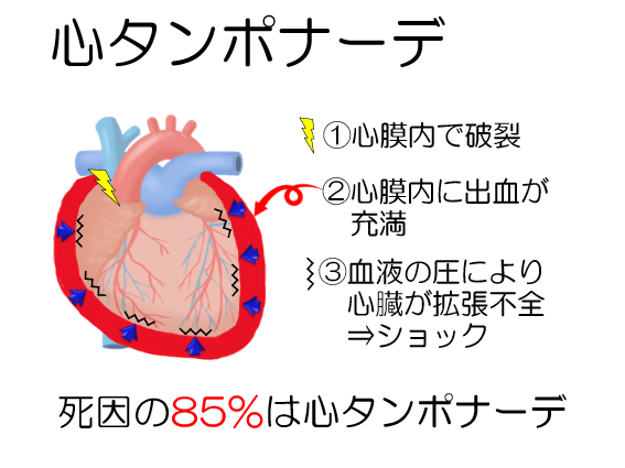 大動脈解離のリハビリテーション 病態 飯沼 優 理学療法士 Note