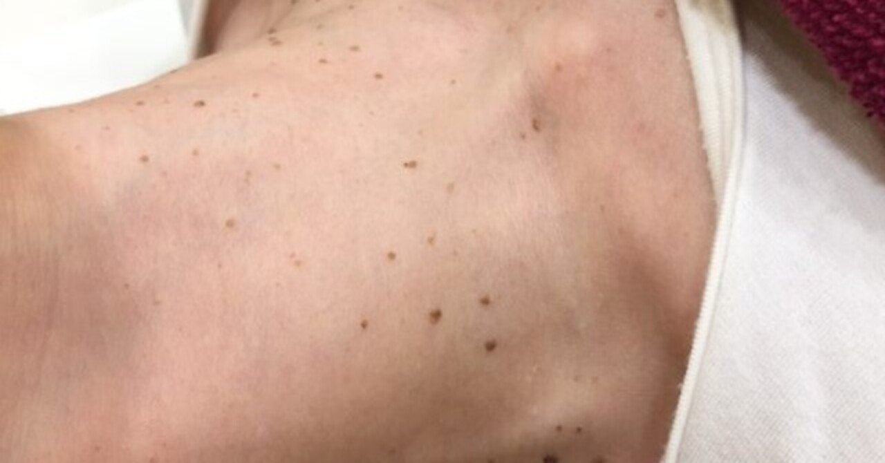 首イボ治療 男女問わず人気です Flalu フラルクリニック Note