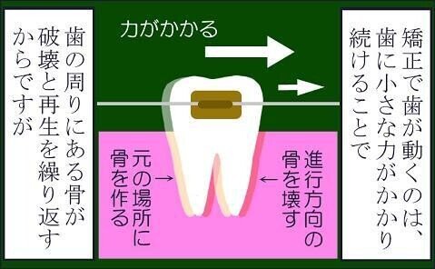 歯科矯正治療（後編）05 【矯正生活09】 つきまとう不安-1