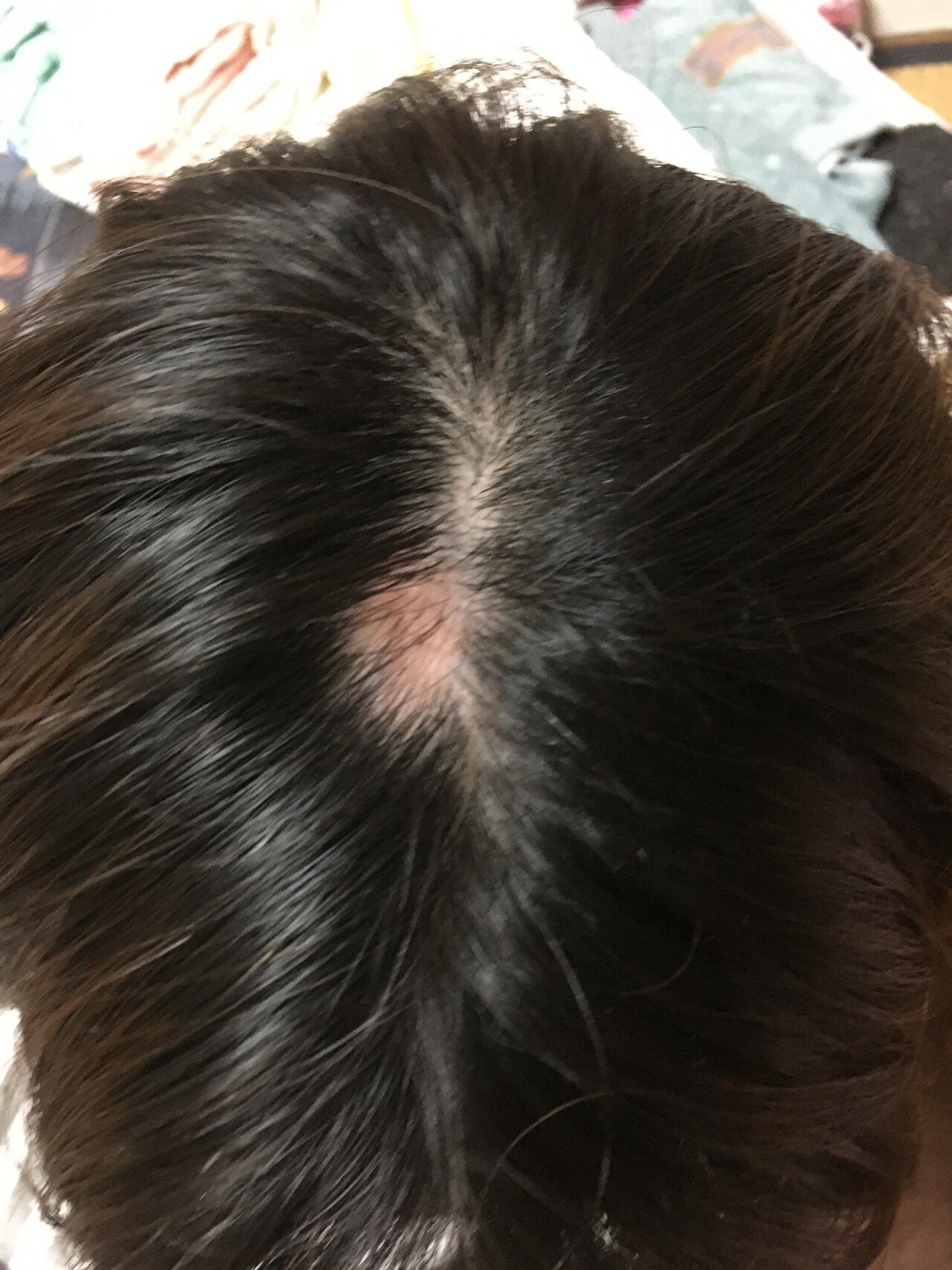 チョコ食べたら禿げた ダダノイア Note