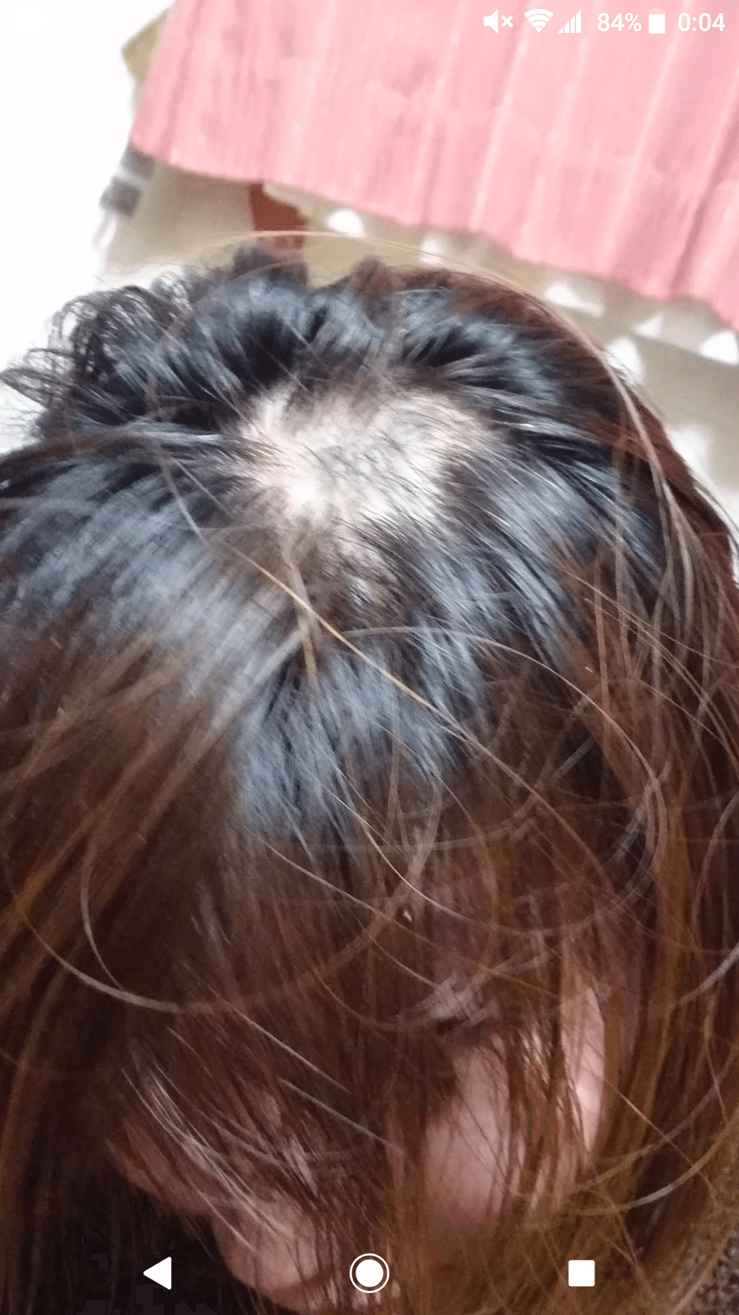 めっちゃ悪化してて笑う チョコ食べたら禿げた のその後 ダダノイア Note