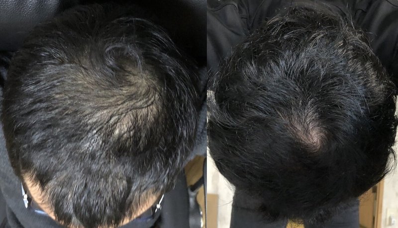 Aga 薄毛 抜け毛に本当に効果のあるシャンプーはひとつだけ 例外あり Agaキツネ Note