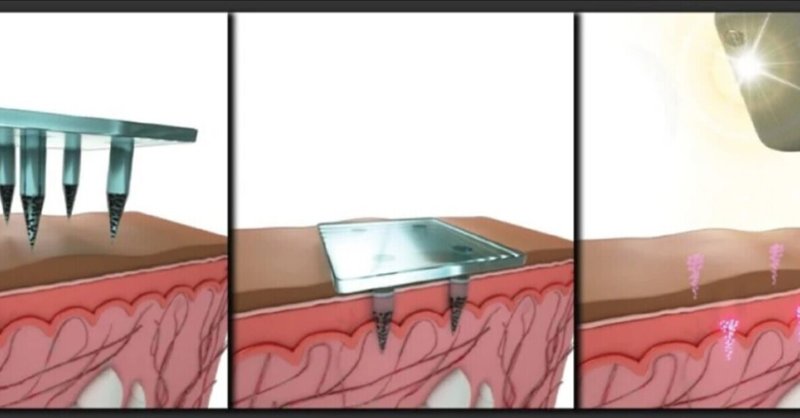 目に見えない量子ドット「タトゥー」は皮膚の表面下に医療情報を保存します。