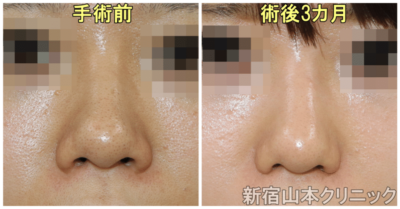 小鼻切ったら 小さくなる 他院術後ならどう 新宿 山本クリニック Note