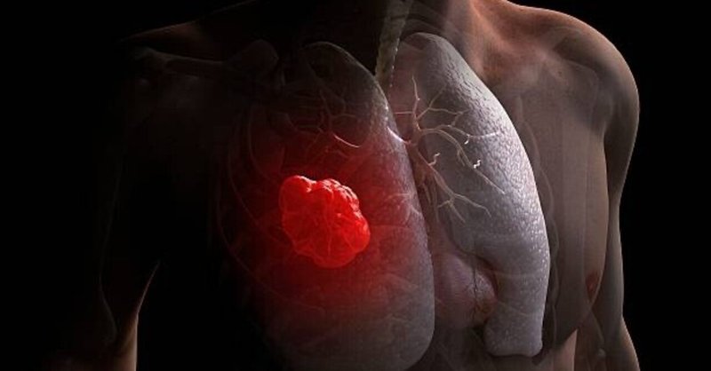 肺癌の発生リスク