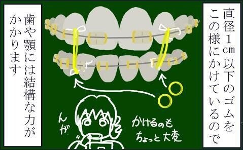 歯科矯正治療（後編）22 【顎間ゴムかけ02】 顎間ゴムの強さ-1
