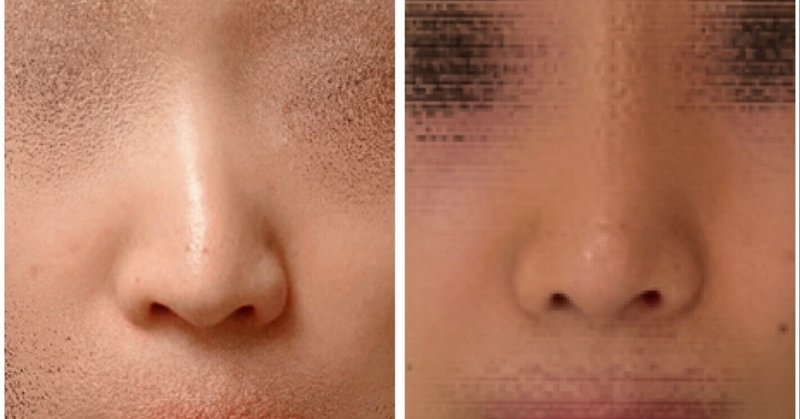 斜鼻 鼻中隔湾曲症の矯正について 麗しのサプリな Note