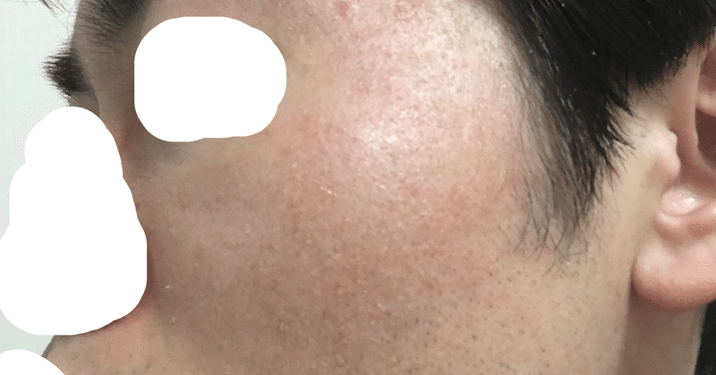 ユースケ 脂漏性皮膚炎から酒さ様皮膚炎を発症 Note ユースケ 脂漏性皮膚炎から酒さ様皮膚炎を発症 Note