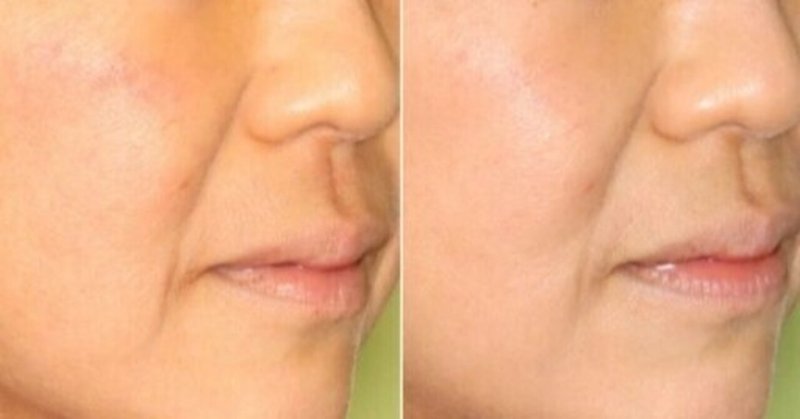 肌の黄ぐすみとピコレーザー ティーズクリニック 形成外科 美容外科 美容皮膚科 Note 肌の黄ぐすみとピコレーザー ティーズクリニック 形成外科 美容外科 美容皮膚科 Note