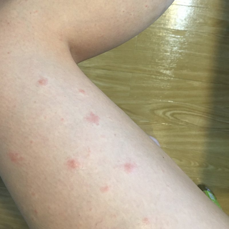 自分の皮膚が突然ヤバくなった話 ふじわら Note 自分の皮膚が突然ヤバくなった話 ふじわら Note