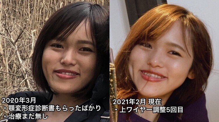 病み期 診断書からワイヤー付くのに8ヶ月かかりました 26歳 顎変形症治療ブログ Note 病み期 診断書からワイヤー付くのに8ヶ月かかりました 26歳 顎変形症治療ブログ Note