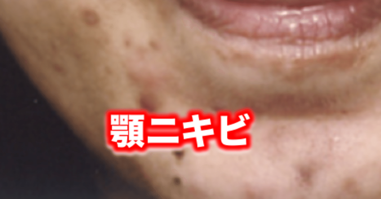 顎ニキビ 片柳ちひろ ニキビ博士 Note
