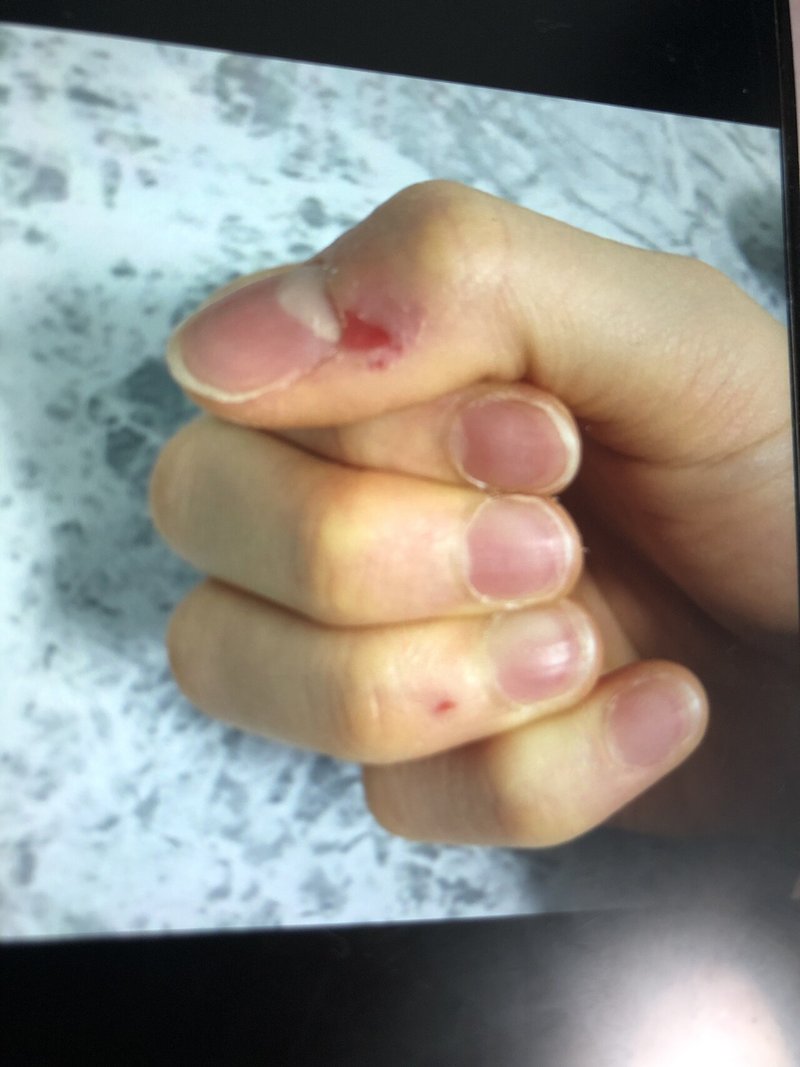 皮膚むしり症が治った話 2 Kikka 18 Note 皮膚むしり症が治った話 2 Kikka 18 Note