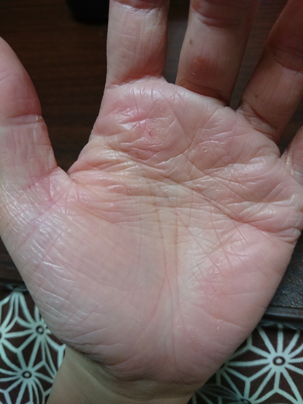 02 15 21 痒くはないが いつもの気持ち悪いやつが出てる ダダノイア Note