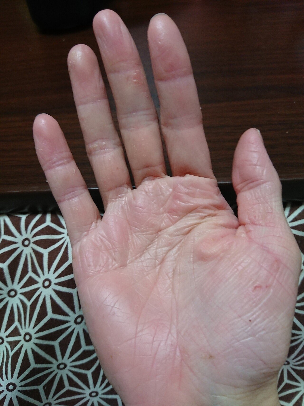 02 15 21 痒くはないが いつもの気持ち悪いやつが出てる ダダノイア Note