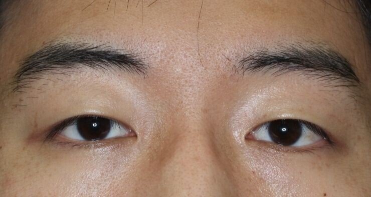一重まぶたから自然な二重まぶたにする二重整形切開法 ティーズクリニック 形成外科 美容外科 美容皮膚科 Note