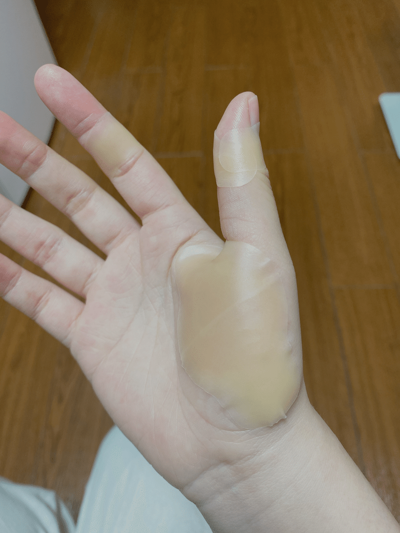 火傷 水ぶくれ 火傷 水ぶくれ