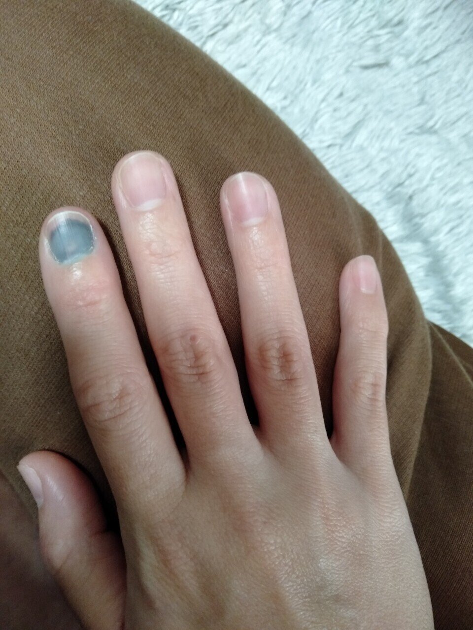 爪下血腫の画像有り注意 杜若茘 Note