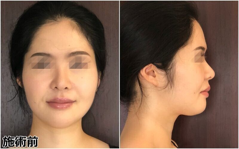 湘南美容クリニックのハイフをうけてみた 値下げしたが効果 は本当にあるのか 術前 照射1ヶ月後の写真あり Seina フリーライター兼カウンセラー Note 湘南美容クリニックのハイフをうけてみた 値下げしたが効果 は本当にあるのか 術前 照射1ヶ月後の写真あり Seina フリーライター兼カウンセラー Note