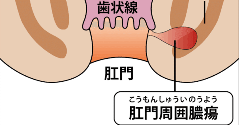 肛門周囲膿瘍 の新着タグ記事一覧 Note つくる つながる とどける