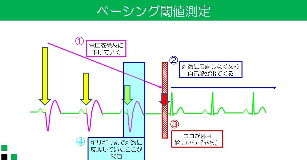 ペーシング閾値ってなに?|ゆるひも@CE ペーシング閾値ってなに?|ゆるひも@CE
