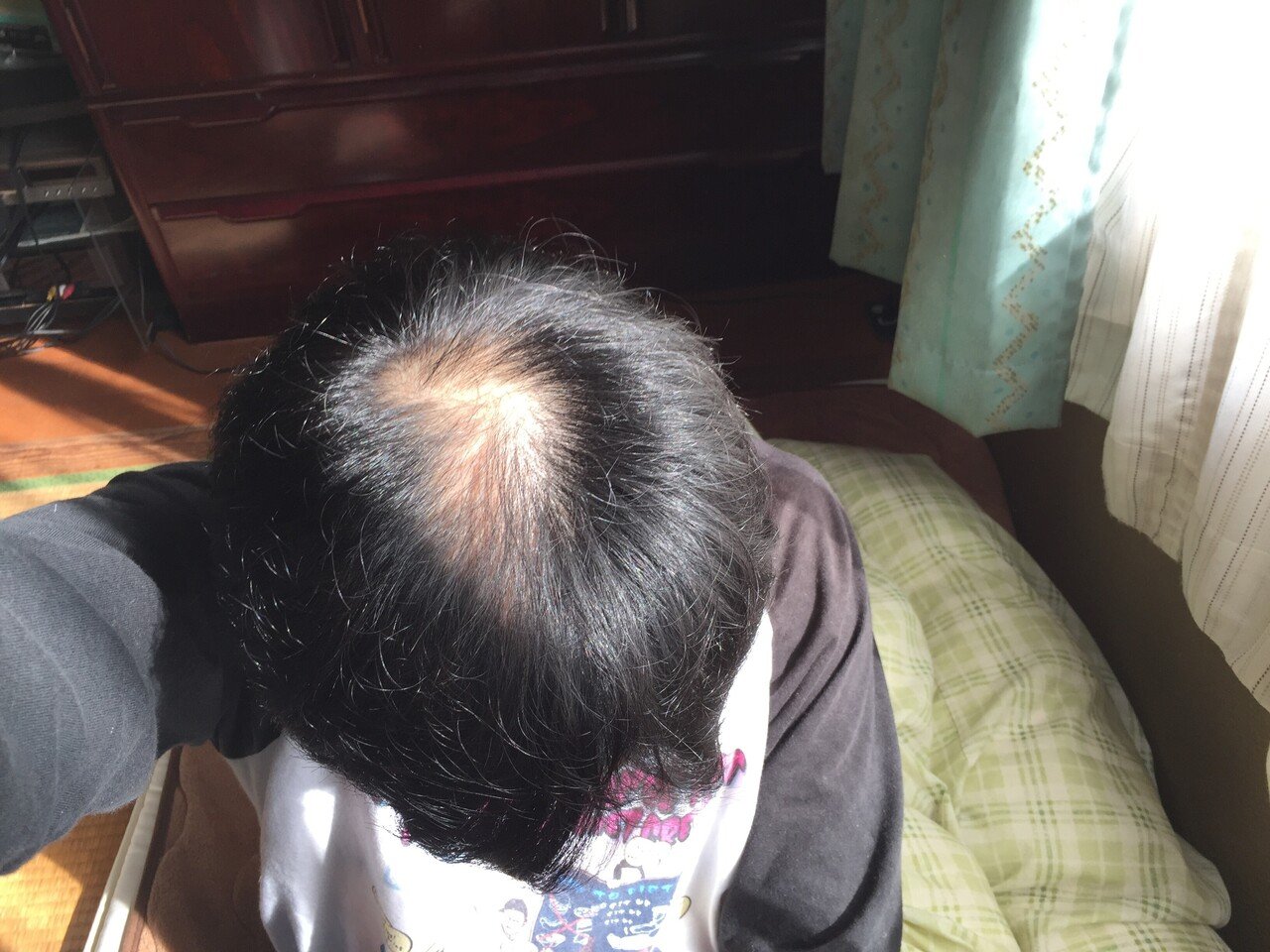 写真有り】1週間経過後｜薄毛改善兄さんかりまる｜note