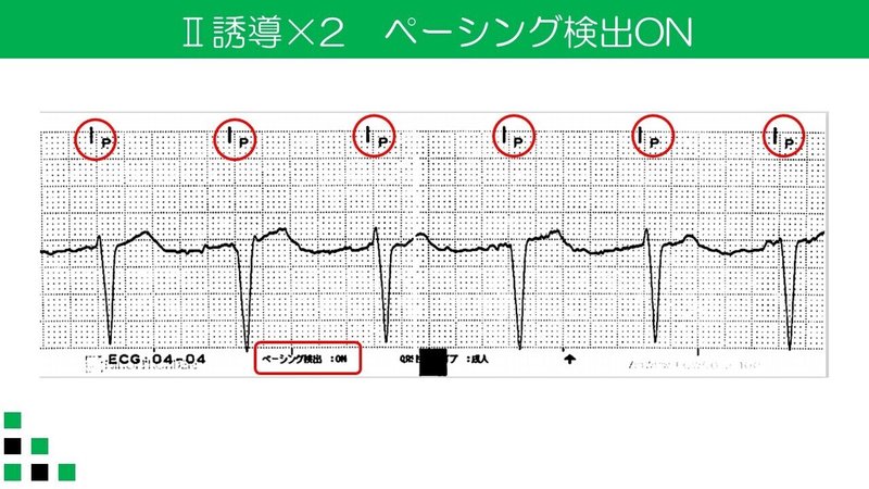 ペーシング検出　Ⅱ誘導×２