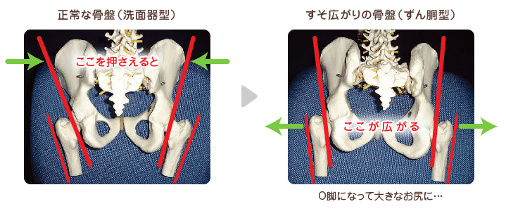 類人猿型骨盤 と ずん胴型骨盤 の治し方 安産力を高めるヨガ みづき 元外資系ヨガインストラクター Note