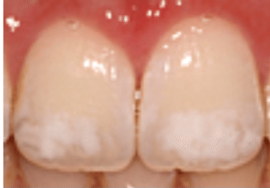 歯を削らない歯の白い斑点 ホワイトスポット 治療 がーみんの歯科治療室 Note