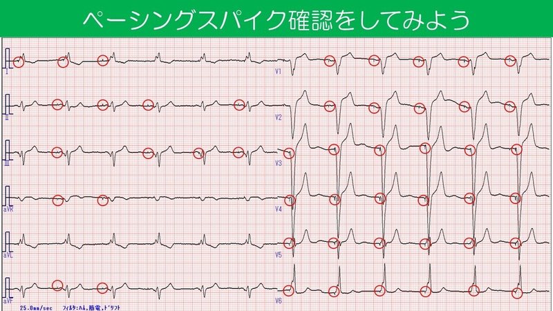 ペーシングスパイクを確認してみよう