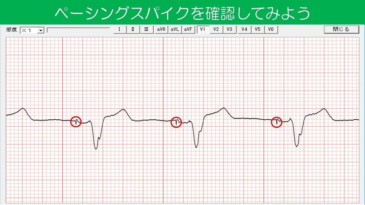 ペーシングスパイク　Aペース