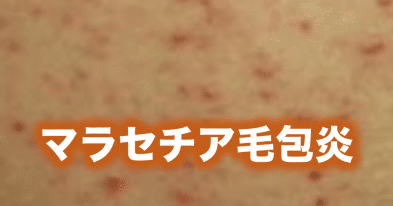マラセチア毛包炎 片柳ちひろ ニキビ博士 Note