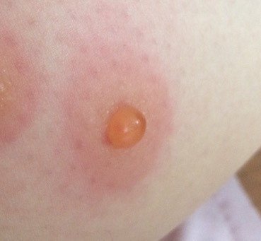 虫に刺されたと思ったら乳首生えてきた くらもと Note 虫に刺されたと思ったら乳首生えてきた くらもと Note
