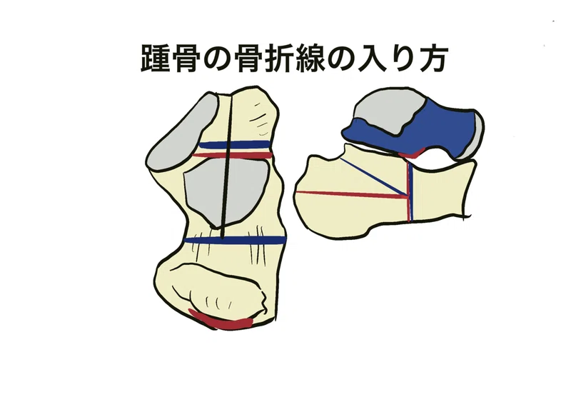 踵骨骨折の分類 Essex Loppresti Radialkawasaki Note