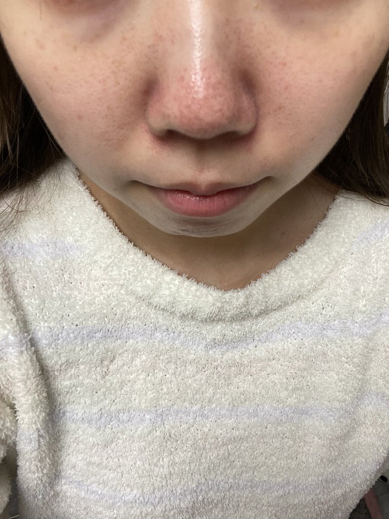 鼻の毛穴が気になる つば エクストラクションの人 Note