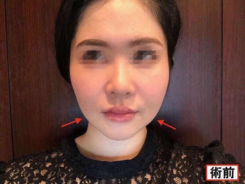 糸リフト体験談 品川美容外科で美肌アモーレをうけてきた 18年9月 Seina フリーライター兼カウンセラー Note