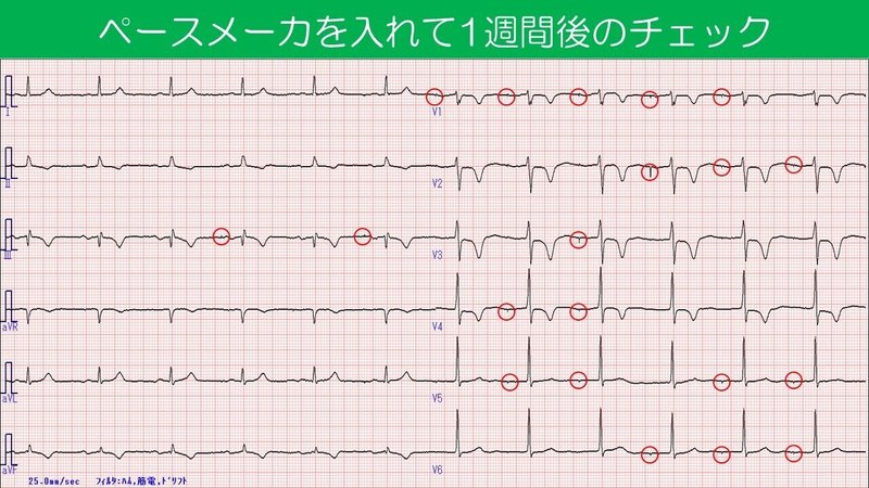 ペースメーカ埋め込み１週間後　スパイクマーカー付き